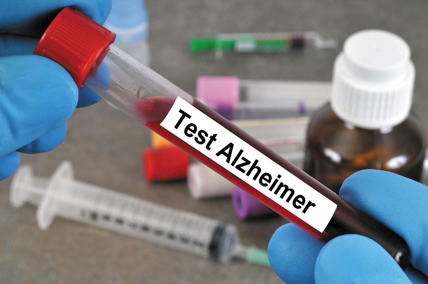 Blood test detects Alzheimer’s 20 ahead of symptoms